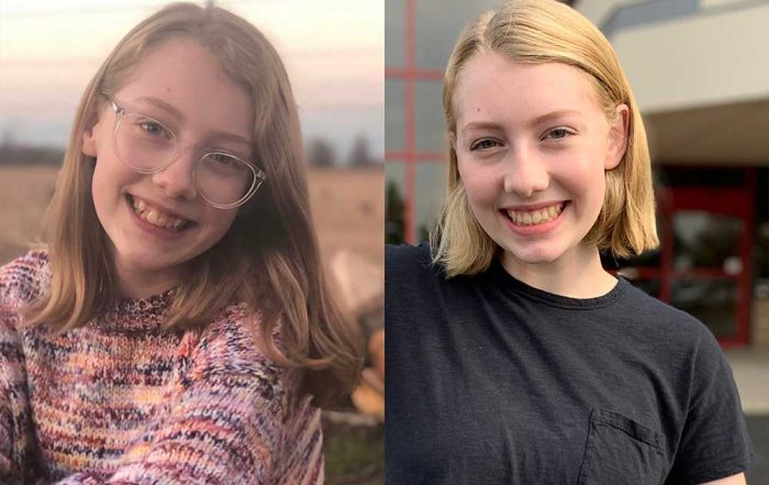 Teen girl's smile transformation after orthodontic braces.